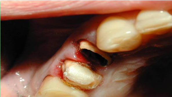 Как убрать подвижность зубов если начали шататься зубы? | Kurtova Dental Clinic