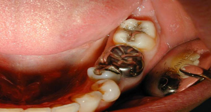 Почему гниют зубы